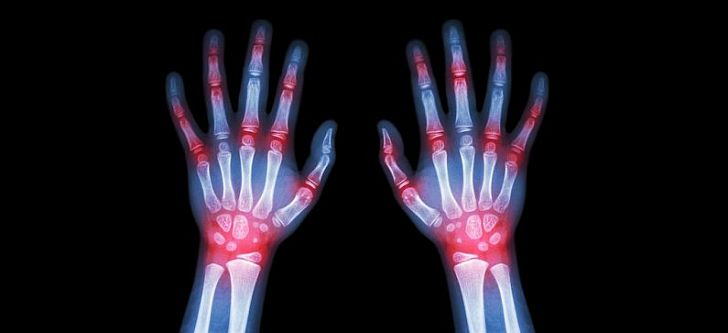 Greek researchers open the way to treat rheumatoid arthritis